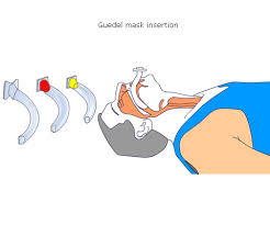 Intubations- und Airwayhilfen